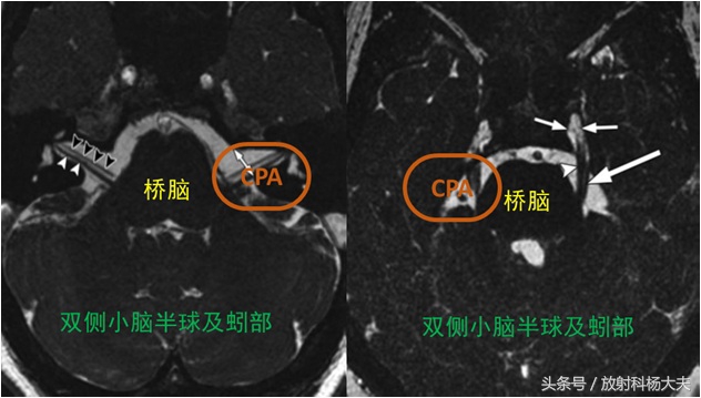 牙痛绝非小事有可能是大病前兆,牙痛可能是什么病的前兆