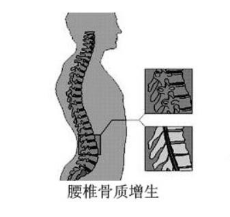 解析骨刺的几大常见问题,骨刺有多可怕视频