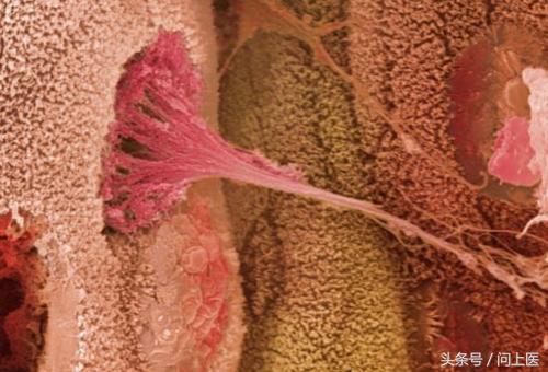 溃疡性结肠炎初期症状及治疗,溃疡性结肠炎症状最新治疗方法