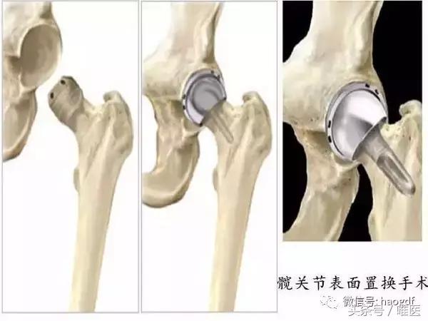 髋关节置换后护理康复训练视频,髋关节置换术后康复护理app