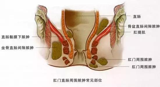 肛周脓肿的原因和症状,让人奔溃的肛周脓肿