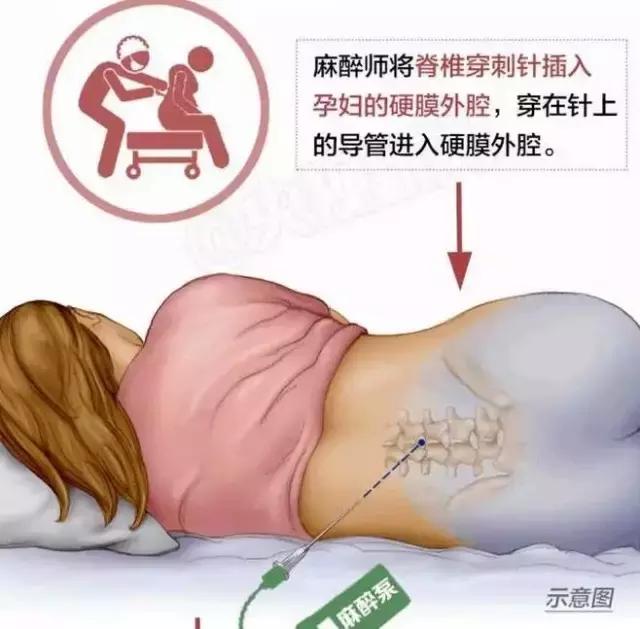 孕妇跳楼事件剖宫产,生孩子剖腹产痛到哭
