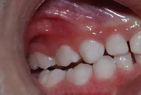 牙齿缝隙有黑的怎样去掉,幼儿的牙齿有黑污垢怎么去掉