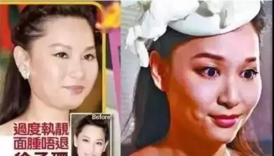 张歆艺打了玻尿酸后的样子,张歆艺下巴打了玻尿酸