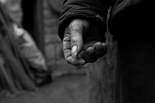 银屑病患者自述康复真实记录,银屑病患者自述真实经历