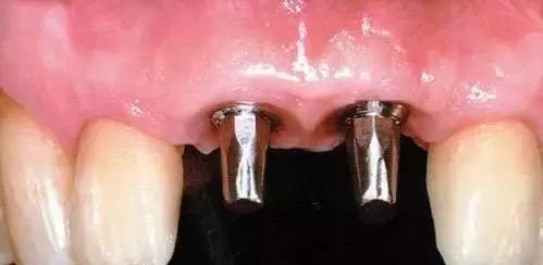 牙龈肿痛牙齿松动是怎么回事,牙齿松动咬硬东西痛怎么回事