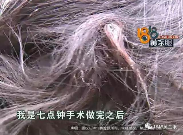 割完双眼皮，头发被胶水粘住！看监控，发现同行的闺蜜有可疑动作