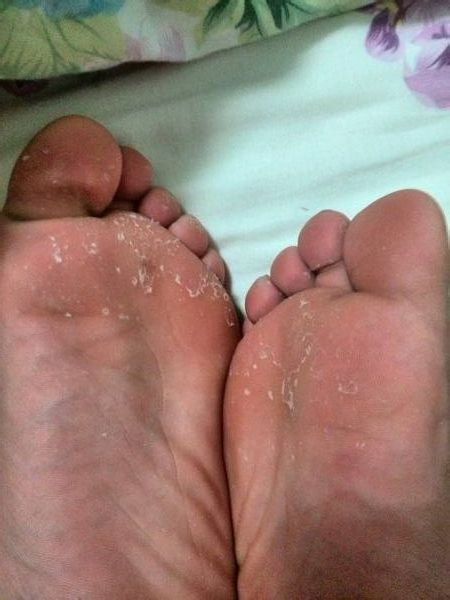小孩脚脱皮不痒只脱皮怎么解决,手为什么会脱皮但脚不脱皮
