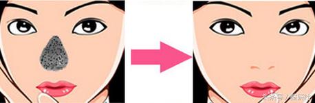 医美去黑头小妙招,医美去黑头有多少种方法