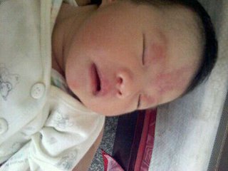 新生儿斑痣多久消退图,新生儿斑痣多久能消退