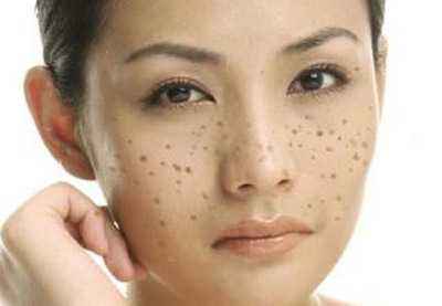 怎样区分自己脸上的斑是什么斑,怎样分辨脸上的斑是什么斑