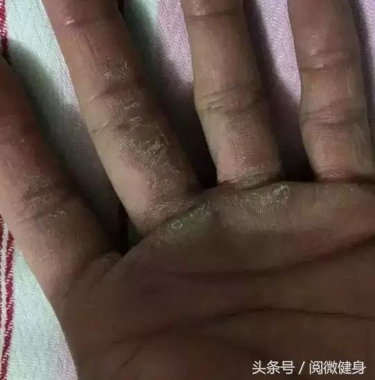 早就说你们别“撸”那么多，后悔了吧，瞅瞅这一个个的手……啧啧