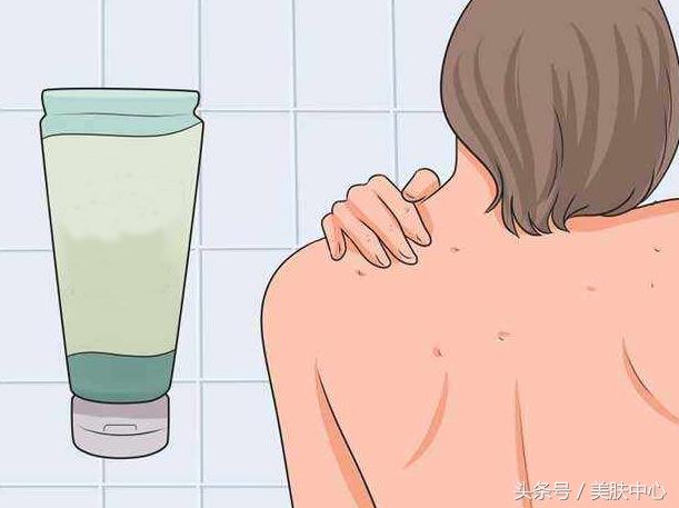 背部长痘痘怎么快速消除,背部痘痘怎么去挤