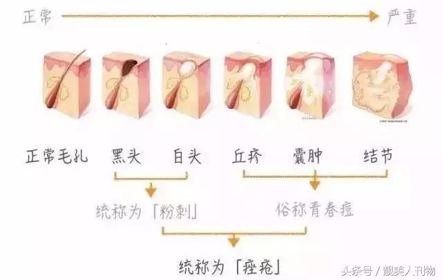 毛孔粗黑头粉刺怎么护肤,毛孔粗大有黑头如何改善真实测评