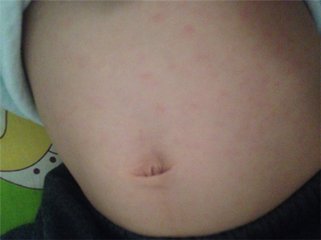 幼儿肚子上起红点点是什么,新生儿肚子有红点是怎么回事