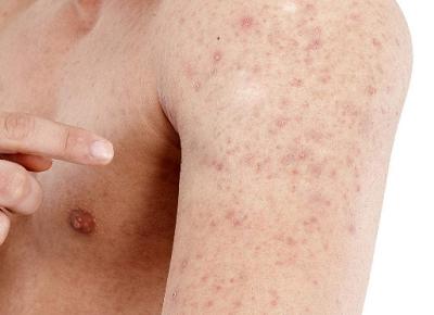 湿疹引起的皮肤瘙痒用什么药膏,湿疹皮肤瘙痒怎么治疗才能断根