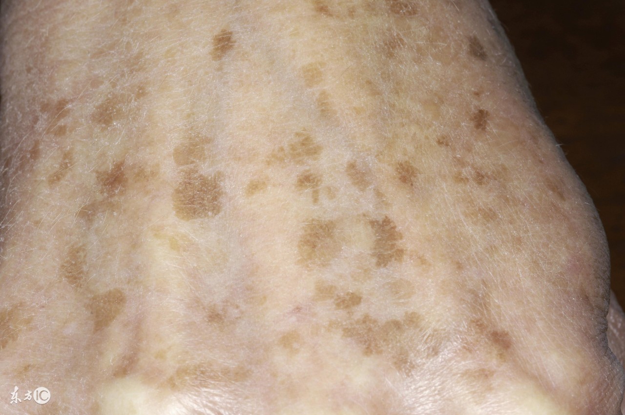 皮肤科医生去除老年斑,有什么办法让皮肤上的老年斑去掉