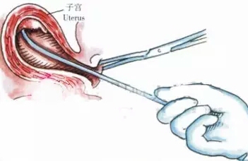 中期引产和晚期引产哪个风险大,引产排出什么才算干净