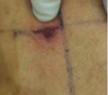 腰椎间盘突出手术切口位置,治疗腰椎间盘突出数千例