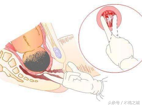 生孩子要十指全开吗,生小孩开一指到十指有多痛