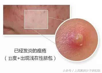 下巴和嘴周围经常冒痘？有对策！