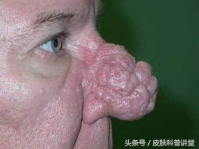 酒渣鼻玫瑰痤疮是怎么引起的,玫瑰痤疮会变成酒渣鼻吗