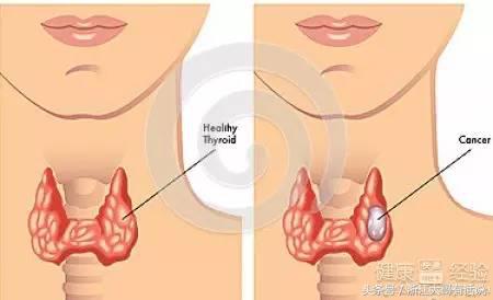 发现甲状腺结节如何处理,发现甲状腺结节怎么处理