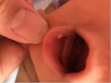 很多新手妈妈都不知道的秘密,揭秘小孩鹅口疮的4个消除方法