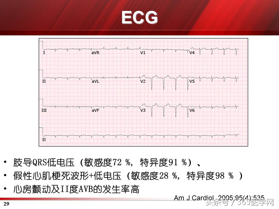心力衰竭心房颤动,心衰时心肌酶的变化