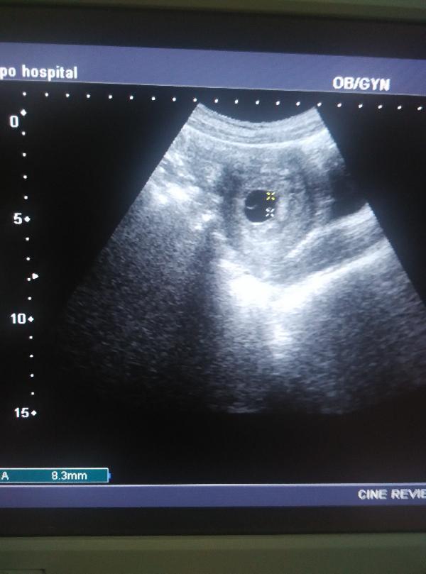 怀孕了不知道做了超声波有影响吗,怀孕了能做妇科超声吗