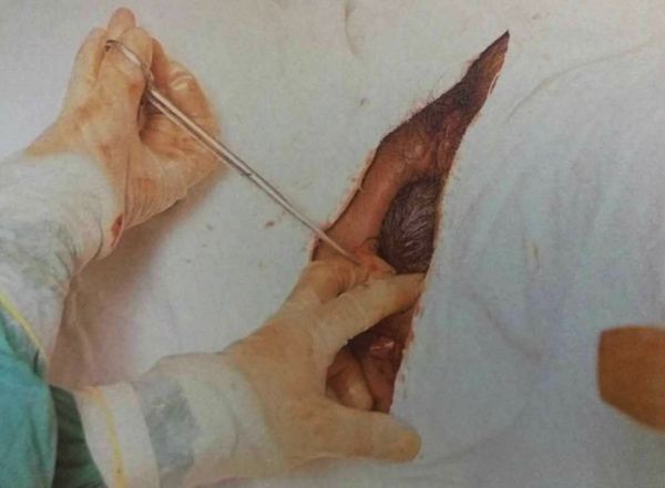 剖腹产修复盆底肌,剖腹产多久可以修复盆底肌