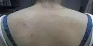 背后长了很多的小米粒用什么药,为什么会长了好多小米粒疙瘩