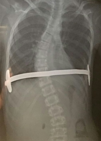 胸廓畸形能恢复吗,高难度胸廓畸形手术