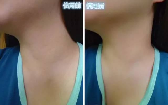 一条颈纹老十岁教你一招淡化,年纪小就有一条很深的颈纹