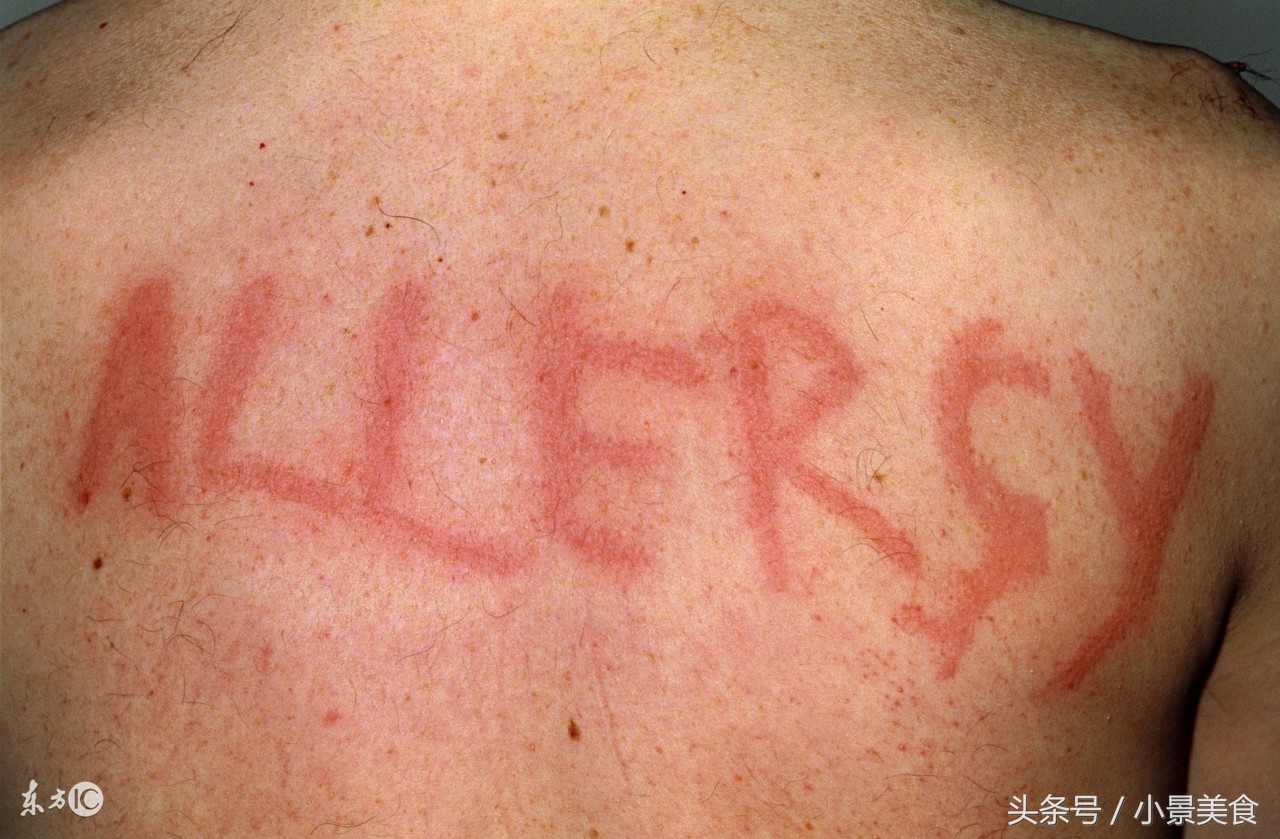 皮肤科医生对付*麻疹荨**的神器，你用过没用？