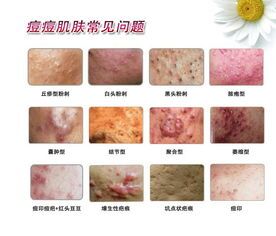 一个大红痘痘周围有许多小痘痘,痘痘中有很多水晶状的痘痘