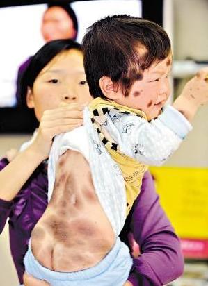 饮食助你除掉脸上黑斑,治脸上的黑斑点小妙招