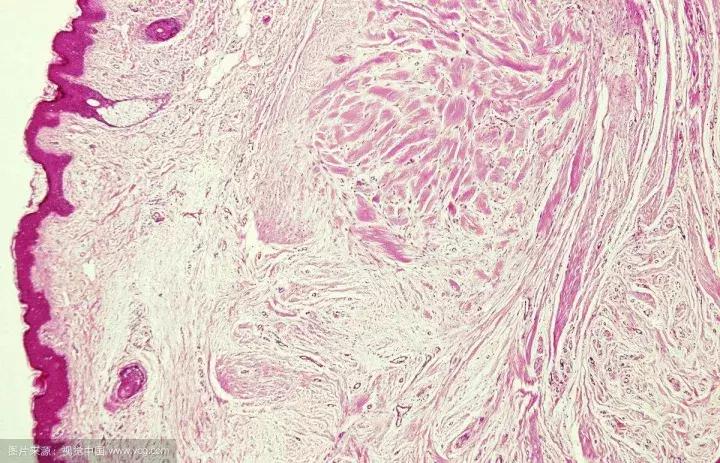 点滴型银屑病痒吗,银屑病为什么会痒呢