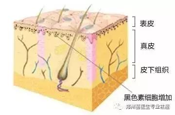 真皮斑是斑中之癌说法对吗,真皮斑为什么叫斑癌