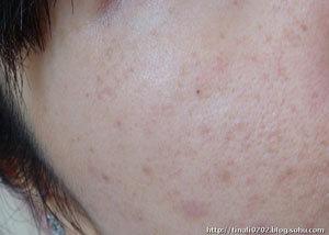 你真的了解痘痘吗,你是真的了解侘寂风吗