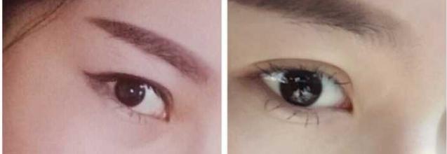如何不做手术让内双眼皮成为外双,刚做的双眼皮如何才能变得自然