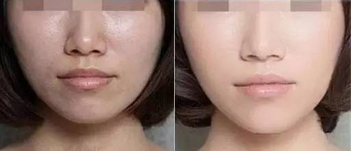 一次水光针1000张面膜6000次普通护肤