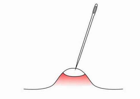 挤完痘痘后皮肤护理视频,挤完痘痘修复视频