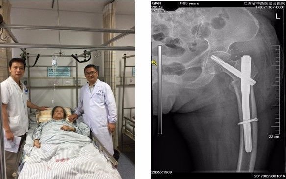 粗隆间骨折做pfna,pfna手术好处