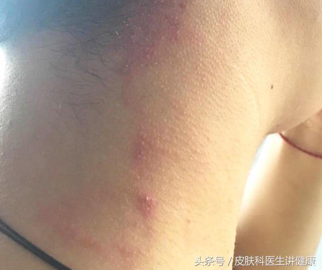 脖子上出现疱疹是怎么回事,前胸起一个红疙瘩是带状疱疹吗