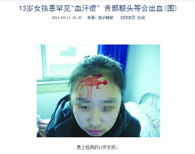 听说过汗血宝马,人身上出血汗非常罕见