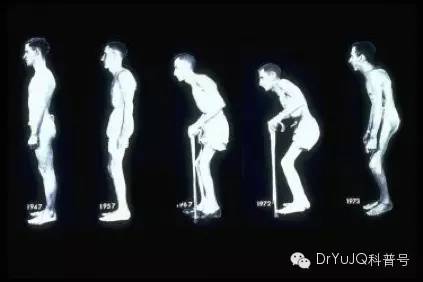 如何诊断脊柱关节病,脊柱关节病的科普知识