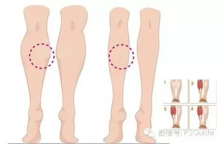 打了瘦腿针走路多影响效果吗,瘦腿针有没有效果有什么副作用