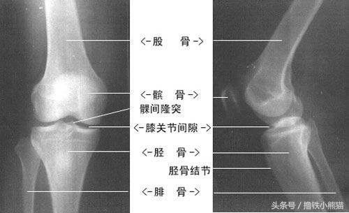 全方位解析，美国专业医生告诉你：膝关节损伤如何识别及自我治疗