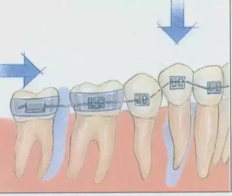 牙套上钢丝了好痛怎么办,牙套上钢丝很紧